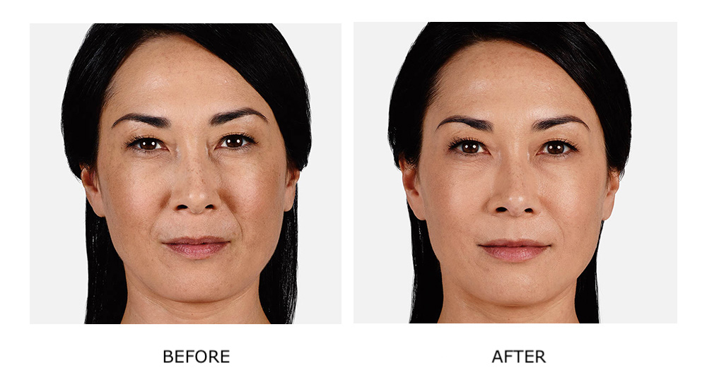 Before and after Juvéderm treatments