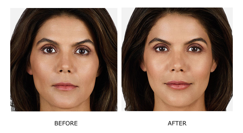 Before and after Juvéderm treatments